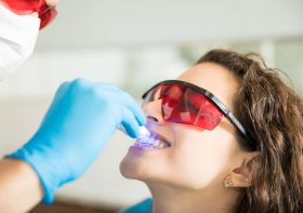 Wybielanie zębów – Jak zrobić to bezpiecznie?