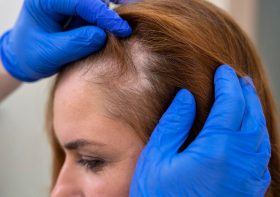Jakie są sposoby leczenia łysienia androgenowego?